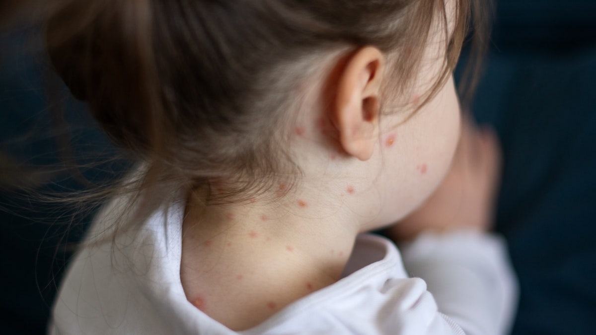 Internet InfoMedia measles cases continue to spread in multiple states following childs death