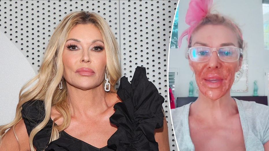 Internet InfoMedia brandi glanville suffers severe chemical burns on her face while trying to self treat mystery illness